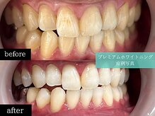 ホワイトニングカフェ 博多駅前店(WhiteningCafe)/◎歯のホワイトニング施術写真◎