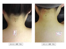 スターポルト(Star-Porte)/襟足脱毛