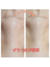 エターナル(Eternal)/気になる/小鼻の黒ずみ/ザラつき