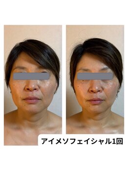 ランネル(Runnel)/アイメソビフォーアフター☆