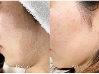 ナナイロサロン ニコリー(NaNairo nicolly)/【顔ワックス×光脱毛】