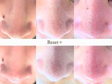 リセットプラス(Reset+)の雰囲気（黒ずみに効果的◎長年のお悩みを毛穴洗浄で解決！）