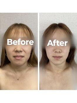 レオ(LEO)/before→after