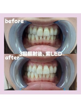 パレ 大阪十三店(Palet)/before/after