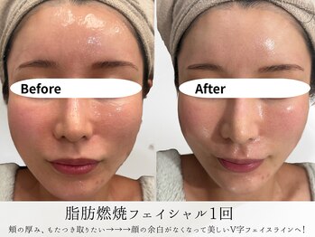 ミヨンラボ(miyon LABO)/小顔フェイシャル1回