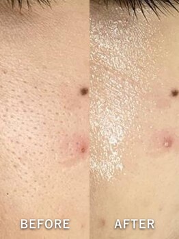 ベルミーランド マルエツ安行慈林/毛穴ケアBeforeAfter