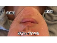 リラクゼーションサロン カネサチ/美肌光フェイシャル