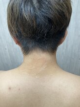 メンズ脱毛 リボーン(reborn)/うなじ