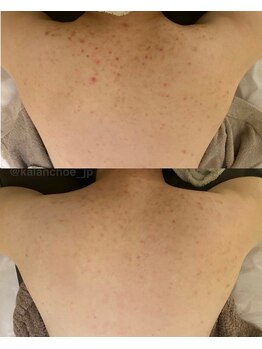 カランコエ(KALANCHOE)/アクネ菌ケアピーリング背中