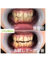 ルブラン 奈良店(Le Blanc)/whiteningに年齢は関係無し