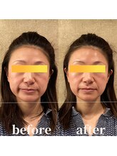 ロータス ビューティー(LOTUS Beauty)/小顔/ほうれい線/リフトアップ