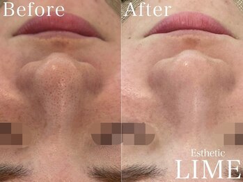 ベル 赤羽(Belle)/ハーブピーリング｜ニキビケア