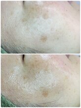 シーカラー 中野栄店(C.color)/シミケア　美肌