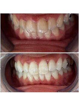 エクシアホワイトニング 代々木店/ホワイトニングビフォーアフター