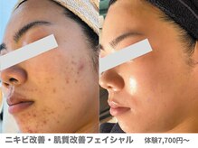 ピュアノア 垂水店/肌質改善フェイシャル　神戸垂水