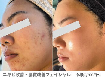 ピュアノア 垂水店/肌質改善フェイシャル 神戸垂水