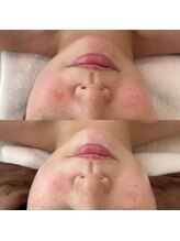 シルク(Silk)/ULDM管理