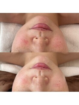 シルク(Silk)/ULDM管理