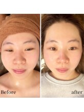 シャラ(shara)/ソフトコルギ小顔矯正