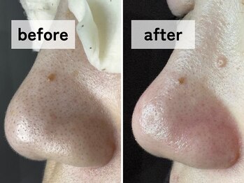 エアル(earu.)/BA|毛穴ケア|ピーリング|高円寺