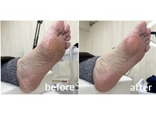 ガサガサ踵やタコ・魚の目もツルツル足美人に!［ネイル/フット］