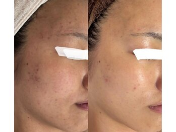 フォー(For...)/クリスティーナメソッド◇3回目