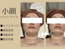 リラエス(Rela S)/二重アゴもスッキリ！