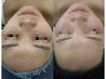 ファーファラ(Farfalla)/ハーブピーリング