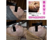 プーモア(Puu Moa)/REVI続けた結果