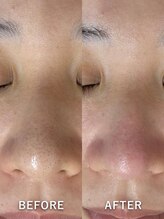 ベルミーランド マルエツ安行慈林/毛穴ケアBeforeAfter