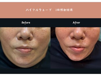 アクアビューティー 金沢(Aqua Beauty)/ハイフルウェーブお顔