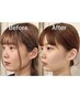 【回数券利用】5回・10回 隆鼻＋輪郭・小顔矯正 40分美鼻/小顔/小顔矯正/博多