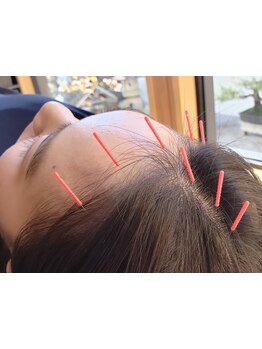 鍼灸施術を受けたい