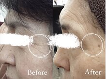 コスメティック雅/【目元の小じわ改善】