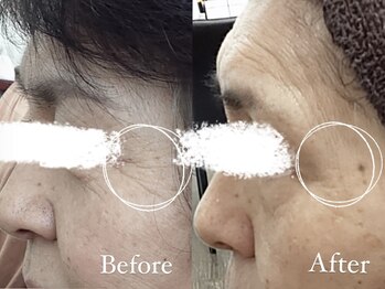 コスメティック雅/【目元の小じわ改善】