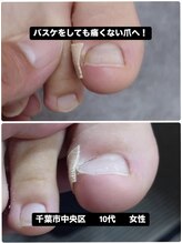 巻き爪じゅん 千葉駅前店/巻き爪による痛み専門施術で改善
