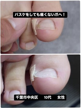 巻き爪による痛み専門施術で改善