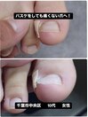 巻き爪による痛み専門施術で改善