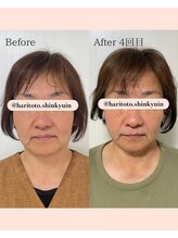 ハリトト鍼灸院/美容鍼灸　施術例　60代女性