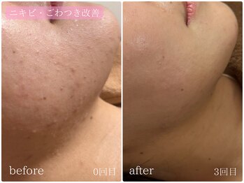 テン(10ten)/ニキビ・ごわつき改善