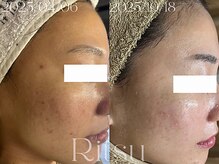 リツ(Ritsu)/ニキビケア/赤み