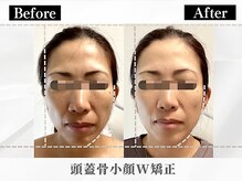 ポーベルポー(Peau Belle poe)/頭蓋骨小顔W矯正＋選べるパック