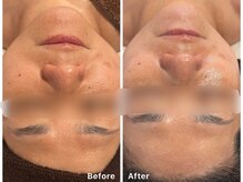 サロンアルーナ(Salon a Luna)/剥離しないハーブピーリング