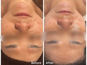 サロンアルーナ(Salon a Luna)/剥離しないハーブピーリング