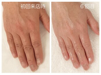 キレイテ 福岡天神店/50代/6回目【福岡ハンドケア】