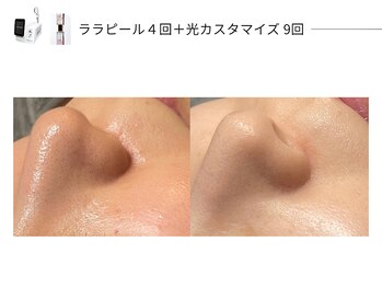 スパレーカ(Spa laka)/光カスタマイズ＋ララピール