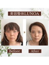 ルノア 梅田院(LUNOA)/小顔矯正[梅田/小顔/たるみ改善]