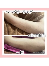 サロンシャイン(Salon Shine)/ハーブピーリング