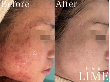 ライム 武庫之荘(LIME)