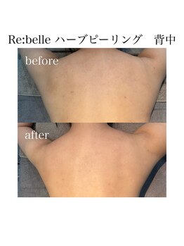 サラ/Re:belle ハーブピーリング